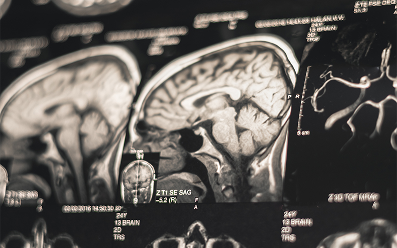 Close-up of a brain MRI scan showing several cross-sectional images of the human head and brain in black, white, and gray tones, with medical annotations and measurements visible on the scans.